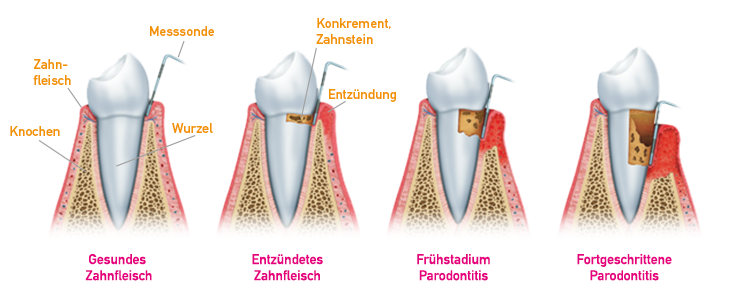 Parodontitis Schaubild